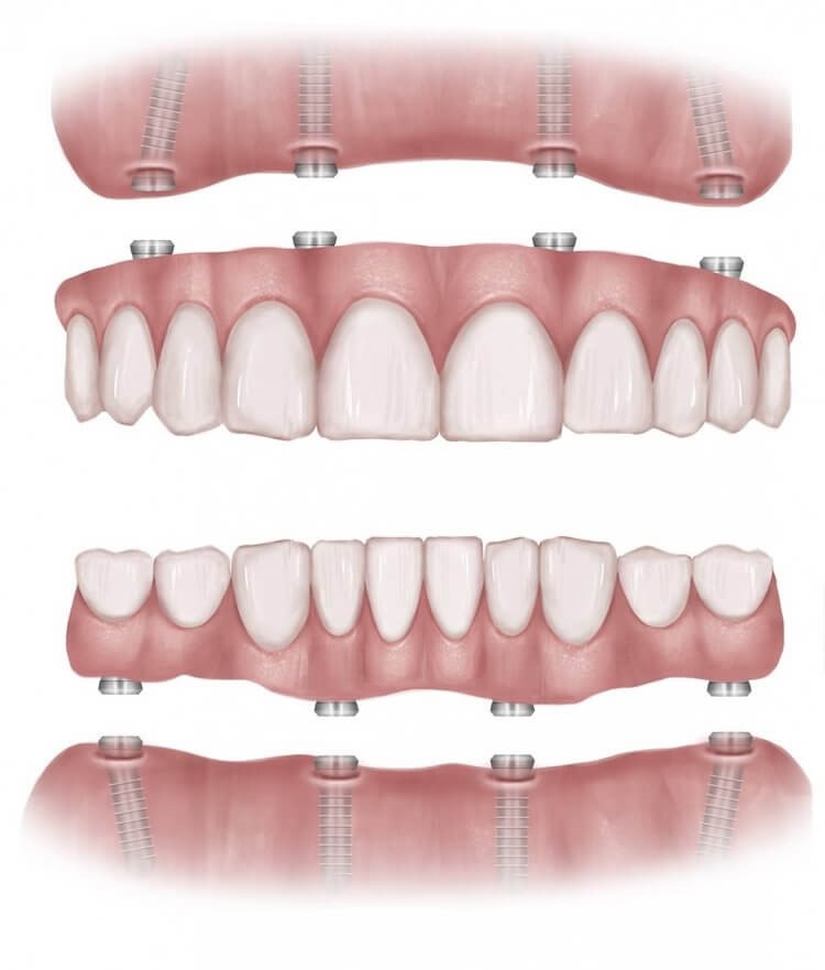 Edmonton denture clinic All-On-4 Dental Implantsaftercare